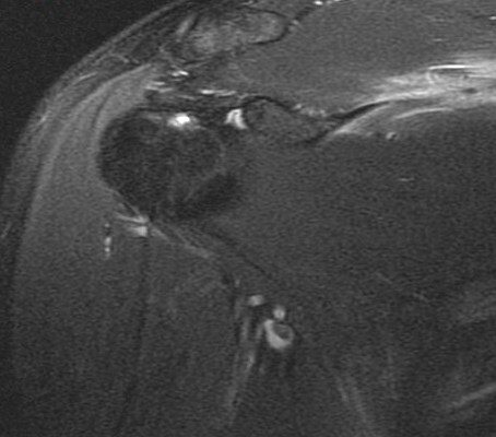 Figure 2 for case scapular fracture and supraspinatus and subscapularis muscle strain ( RID1860 ) ( RID1870 )